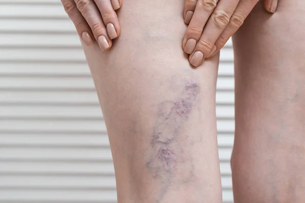 Woman shows leg with varicose veins. Varicose during pregnancy.