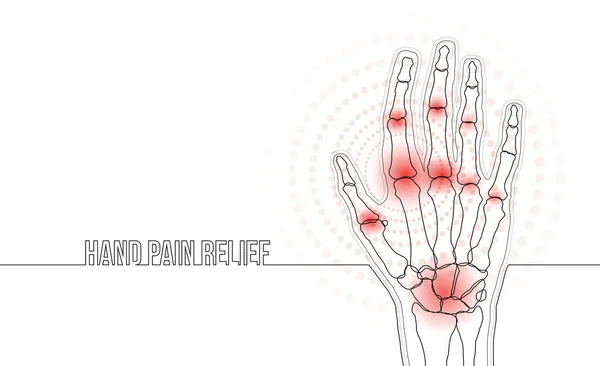 Artrite reumatoide linha contínua ossos da mão desenho conceito banner — Vetor de Stock