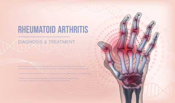 Artrite reumatoide banner deformação das articulações da mão . — Vetor de Stock