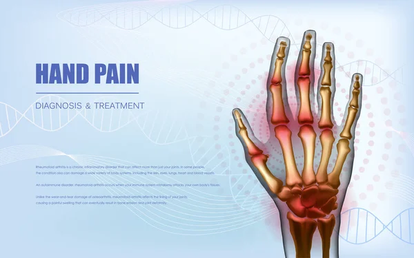 Osteoartrite artrite artrite reumatoide mão dolorosa articulações conceito —  Vetores de Stock