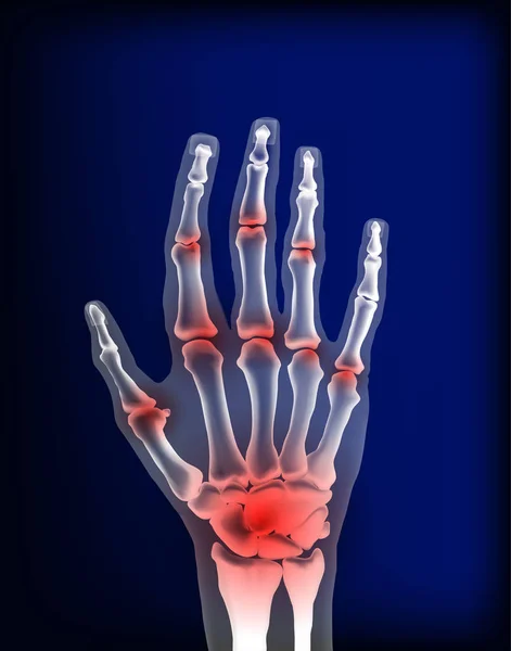 Artrose beeld pijnlijke ontsteking gewrichten van botten de hand. — Stockvector