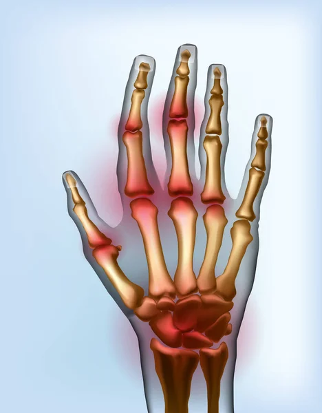 Vue frontale image douloureuse arthrose articulations des os la de la main . — Image vectorielle