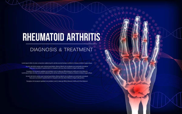 Rheumatoid arthritis osteoarthritis banner inflammation joints of bones of hand. — Stock Vector