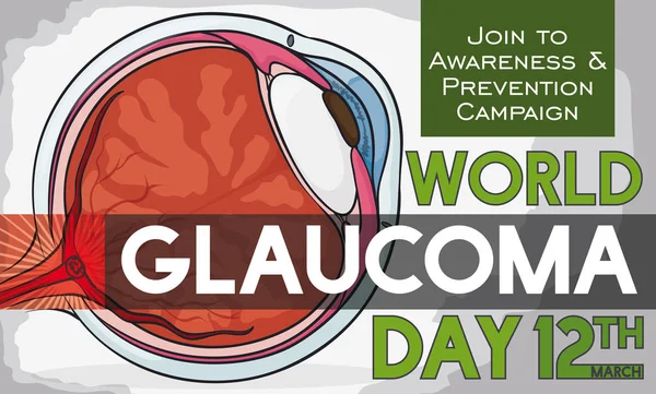 Enfermo globo ocular con recordatorio Fecha para el Día Mundial del Glaucoma, Vector Ilustración — Vector de stock