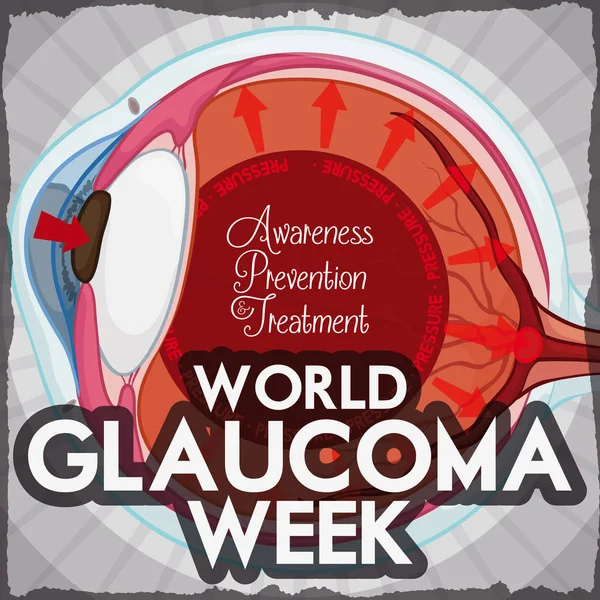 Design settimana glaucoma con occhio interessato per alta pressione intraoculare, illustrazione vettoriale — Vettoriale Stock
