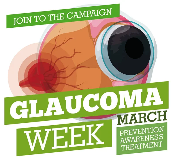 Propaganda preventiva con bulbo oculare malato per la settimana del glaucoma, illustrazione vettoriale — Vettoriale Stock