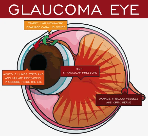 Informazioni sul glaucoma e la sua evoluzione nell'occhio, illustrazione vettoriale — Vettoriale Stock