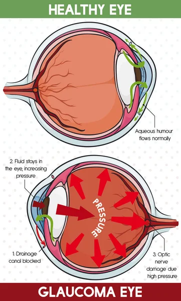 Vergelijkende informatie tussen gezonde oog en glaucoom oog, vectorillustratie — Stockvector
