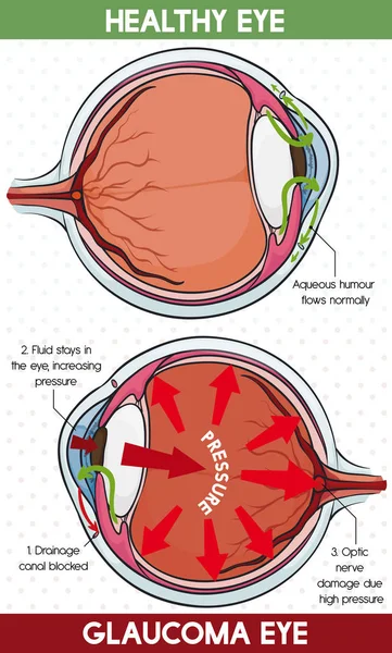 Dane porównawcze między jaskra oka, ilustracji wektorowych i zdrowe — Wektor stockowy
