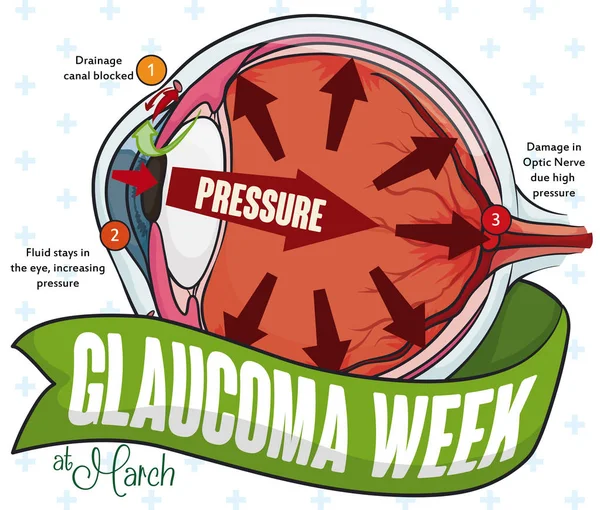Herdenkingsmunt Infographic voor glaucoom Week viering, vectorillustratie — Stockvector