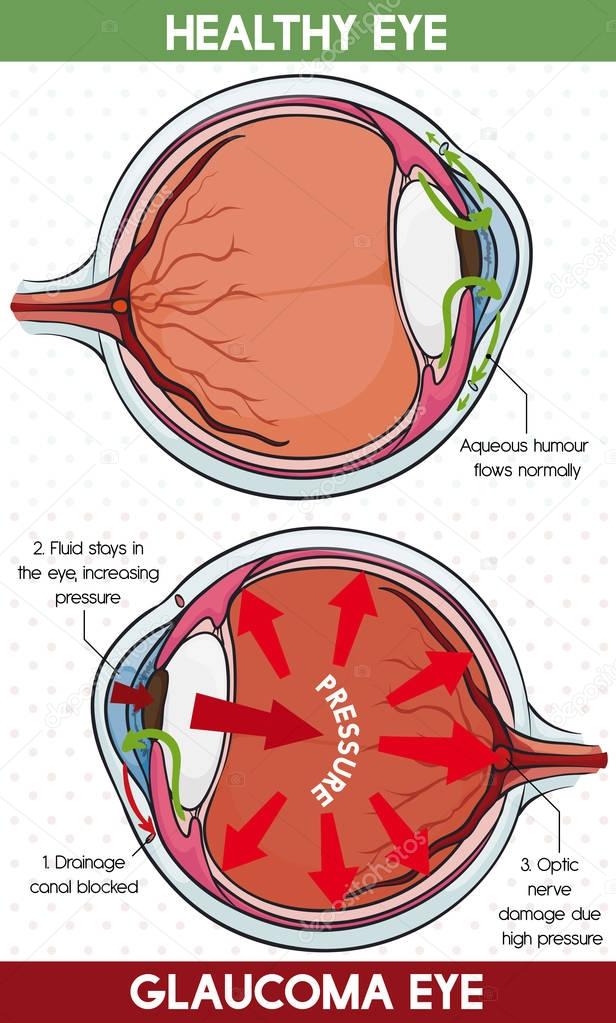 Comparative Information Between Healthy Eye and Glaucoma Eye, Vector Illustration