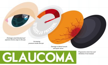 Descriptive Infographic Showing Some Stages of Glaucoma Disease, Vector Illustration clipart