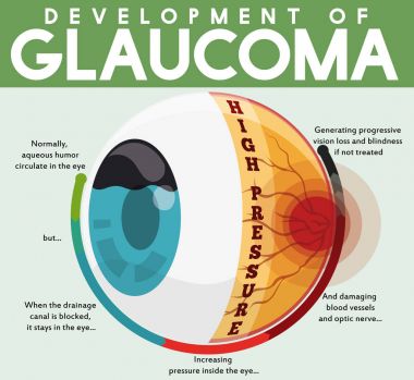 Infographic with Development of Untreated Glaucoma Disease, Vector Illustration clipart