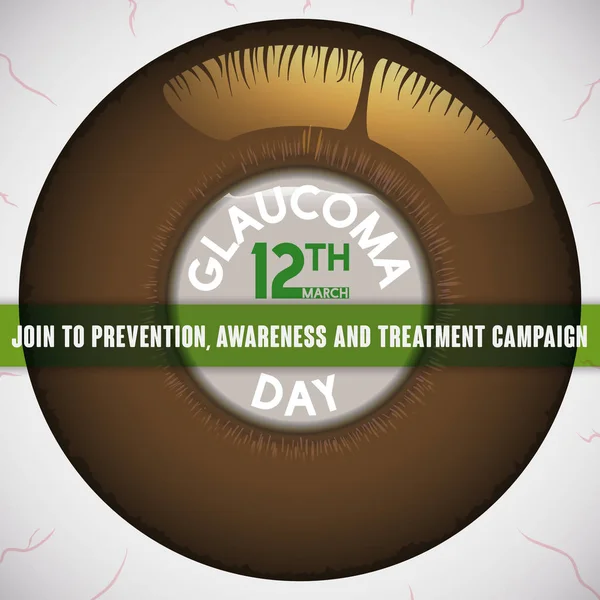 Ojo enfermo con córnea edematosa que promueve campaña preventiva contra el glaucoma, ilustración vectorial — Vector de stock