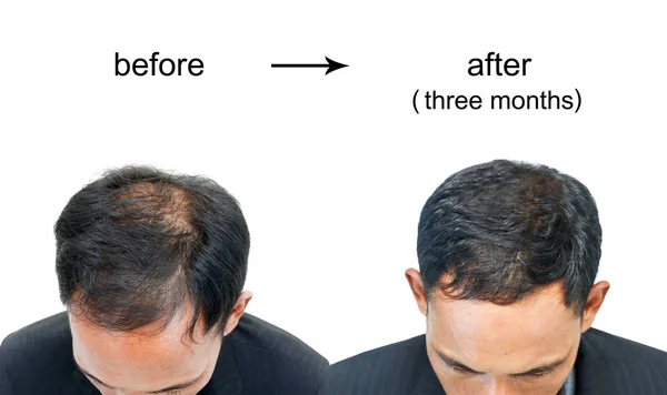 Vor Und Nach Der Glatze Eines Mannes Auf Weißem Hintergrund Stockbild
