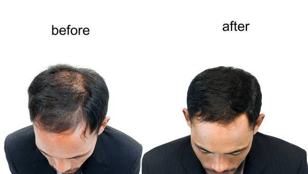Vor Und Nach Der Glatze Eines Mannes Auf Weißem Hintergrund Stockfoto