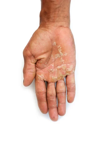 Poor Hands Hard Dry — Stock Photo, Image