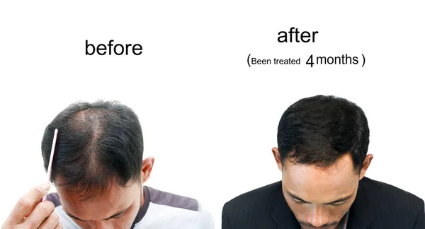 Vor Und Nach Der Glatze Eines Mannes Auf Weißem Hintergrund Stockbild