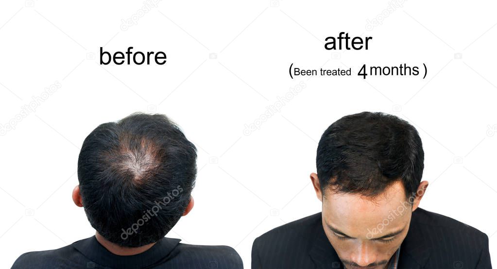  before and after bald head of a man on white background.