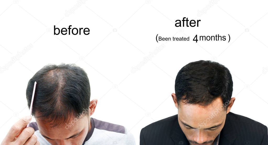  before and after bald head of a man on white background.