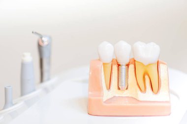 Diş protezi takma diş. Diş sağlığı danışmanlığında diş sağlığı ve sağlık konsepti.