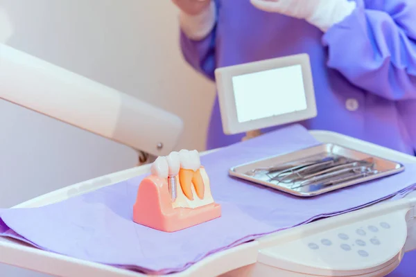 Kunstgebit Implanteren Tandheelkunde Gezondheidszorg Concept Tandheelkundige Kliniek — Stockfoto