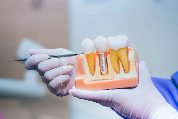 Dentista Com Implante Dentário Dentes Falsos Conceito Odontologia Saúde Clínica — Fotografia de Stock