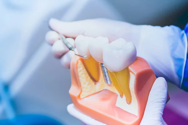 Dentista Con Implante Dental Dientes Postizos Concepto Odontología Salud Clínica — Foto de Stock