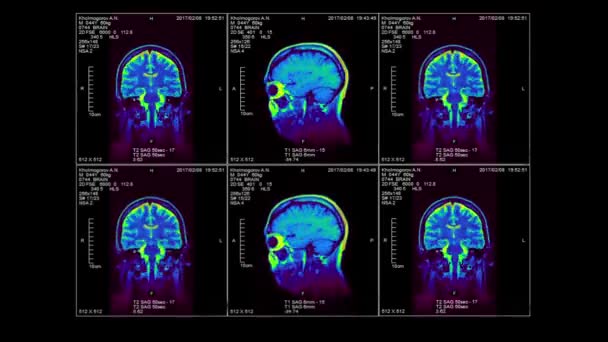 MRI mózgu w trzech wymiarach, wideo pętli, kanał alfa — Wideo stockowe