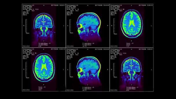 MRI mozku ve třech rozměrech, video smyčky, alfa kanál — Stock video