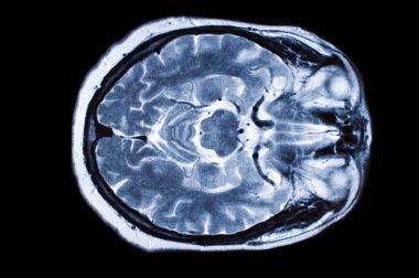x-ray görüntü beyin bilgisayarlı tomografi