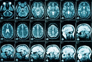 x-ray görüntü beyin bilgisayarlı tomografi