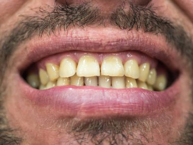 Yüzünün erkek kısmına odaklanmış yakın plan fotoğraf. Dişlerinde plaket olan bir sırıtış.