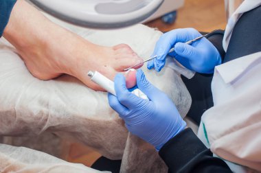Podoloji tedavisi. Ayak tırnağı mantarını tedavi eden pediatrist. Doktor nasırları, nasırları ve içe göçmüş tırnağı alıyor. Donanım manikürü. Sağlık, vücut bakımı konsepti. Seçici odak