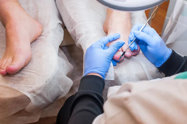 Podologibehandling. Fotvårdsspecialist som behandlar tånagelsvamp. Läkaren tar bort förhårdnader, liktornar och behandlar inåtväxande naglar. Hårdvarumanikyr. Hälsa, kroppsvård koncept. Selektiv inriktning — Stockfoto