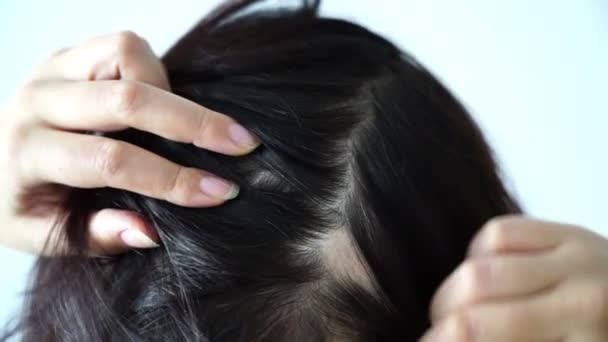 Alopecia mujeres pérdida de cabello mujer encontró alto templo en la parte posterior de la cabeza por las manos tocando — Vídeos de Stock