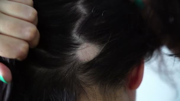 Alopecia mujeres pérdida de cabello mujer encontró alto templo en la parte posterior de la cabeza por las manos tocando — Vídeos de Stock