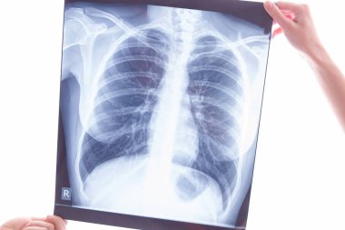 Onkolojik hastalık konsepti. Akciğer kanserini incelemek için ellerinde röntgen olan eller.