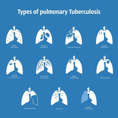 Tüberküloz türleri. Vektör siluet insan vücudu organı - trake akciğerlere tıbbi çizim. Poster Kliniği, hastane için. Solunum sistemi