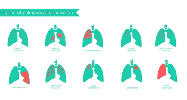 Tipos de tuberculose. Sílhueta vetorial médica — Vetor de Stock