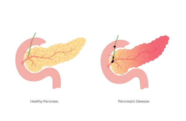Vektor diisolasi ilustrasi pankreas - Stok Vektor