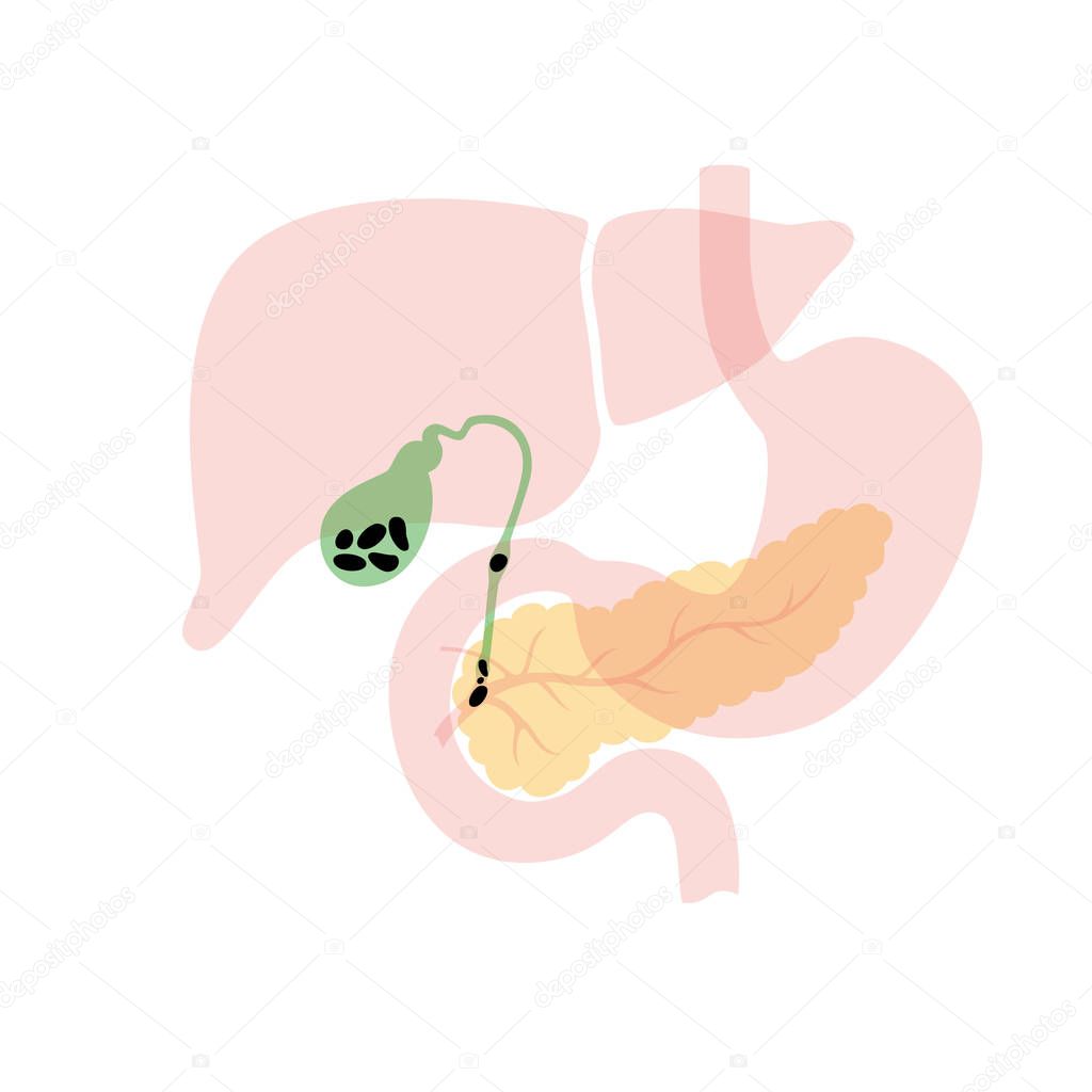 Vector isolated illustration of ill pancreas anatomy. Stones in gallbladder and ducts. Human digestive system icon. Healthcare  hospital, clinic logo. Internal organ symbol poster design