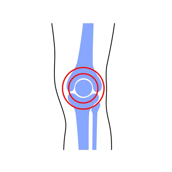 Douleur articulaire du genou — Image vectorielle