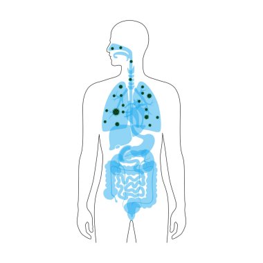 Virüs enfeksiyonu olan insan ciğerleri