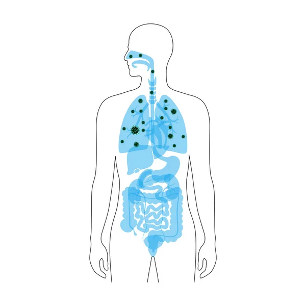 Menschliche Lungen mit Virusinfektion — Stockvektor
