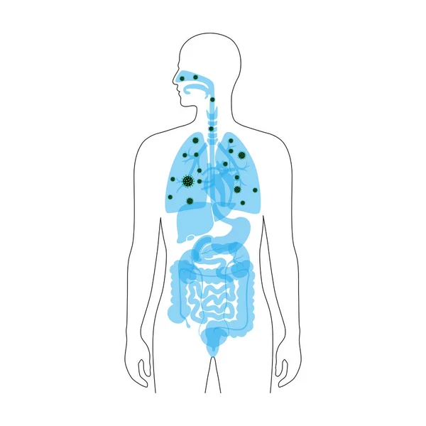 Human lungs with virus infection — Stock Vector