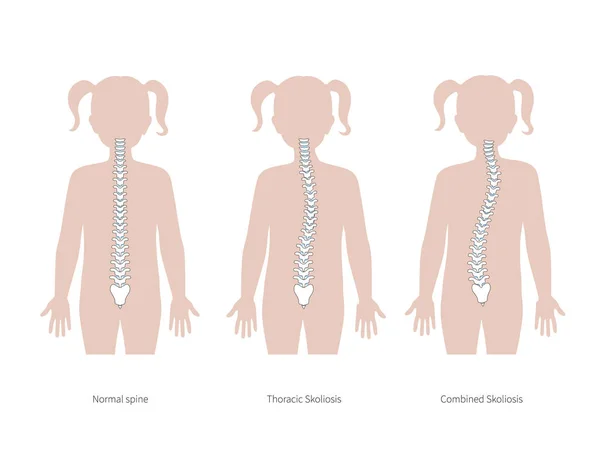 Scoliosis flat vector illustration — Stock Vector