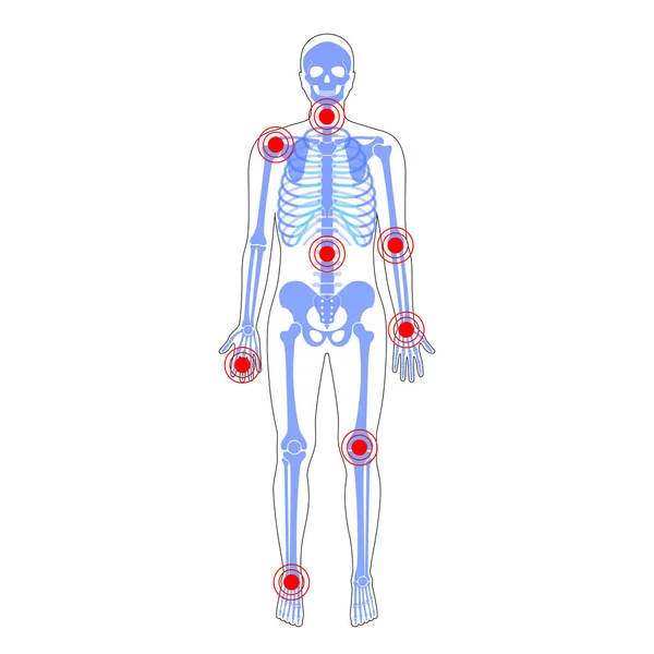 Gewrichtspijn op het skelet in het menselijk lichaam — Stockvector
