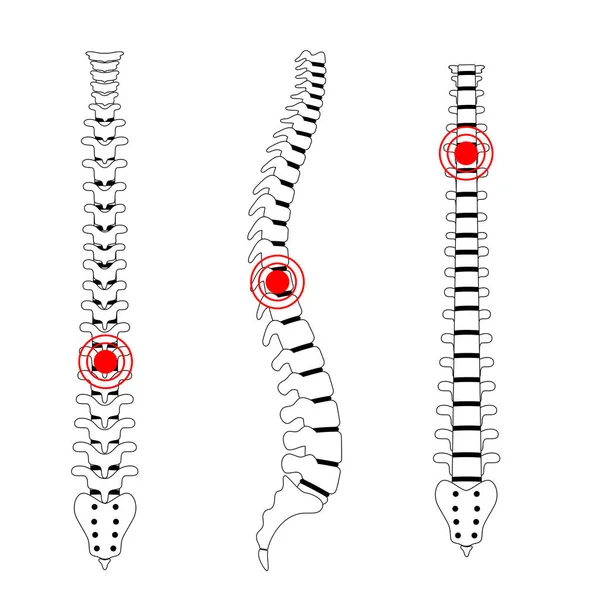 Illustration vectorielle de la douleur vertébrale humaine — Image vectorielle