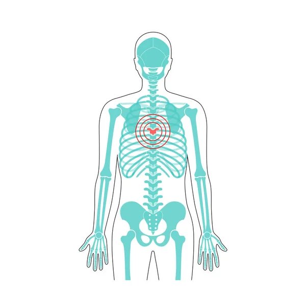 Abbildung zum Schmerzvektor der menschlichen Wirbelsäule — Stockvektor
